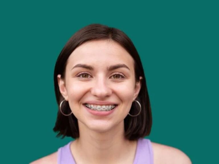 Fastbraces triangular bracket system on patient teeth